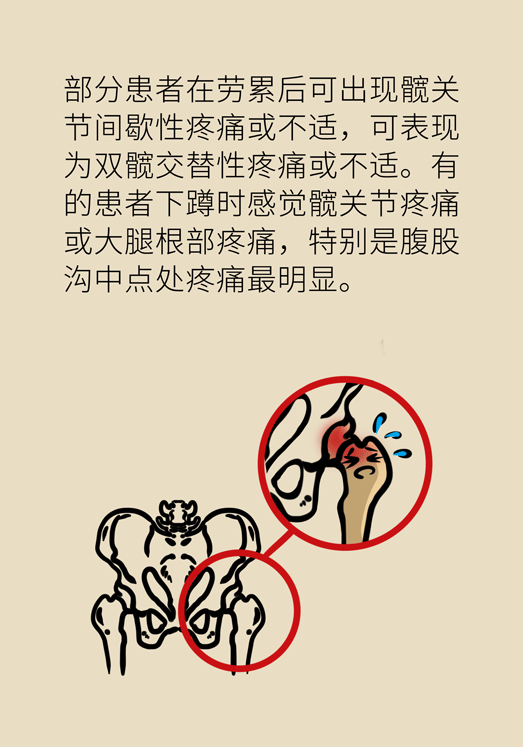 激素會帶來股骨頭壞死的后遺癥嗎？
