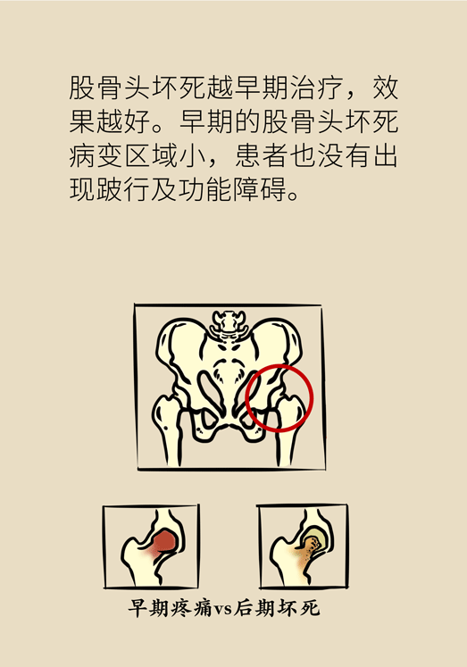 激素會帶來股骨頭壞死的后遺癥嗎？