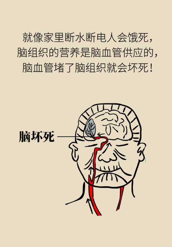 腔隙性腦梗死一定是腦血管堵了嗎？