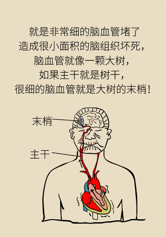 腔隙性腦梗死一定是腦血管堵了嗎？