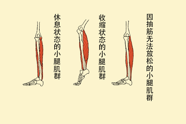 為什么缺鈣會導(dǎo)致抽筋？
