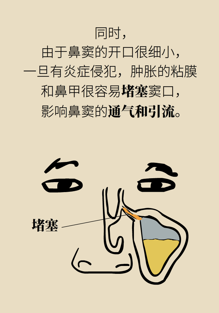 為什么鼻竇發(fā)炎，疼的卻是頭、眼和牙？