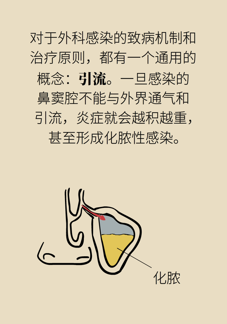 為什么鼻竇發(fā)炎，疼的卻是頭、眼和牙？