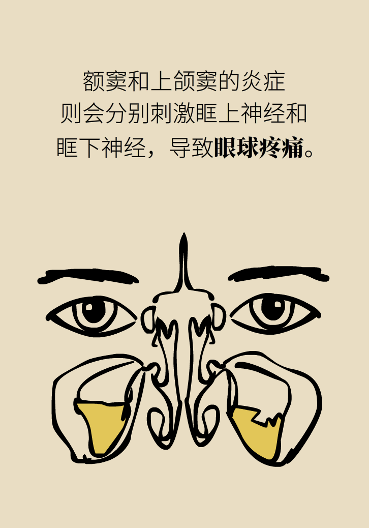 為什么鼻竇發(fā)炎，疼的卻是頭、眼和牙？