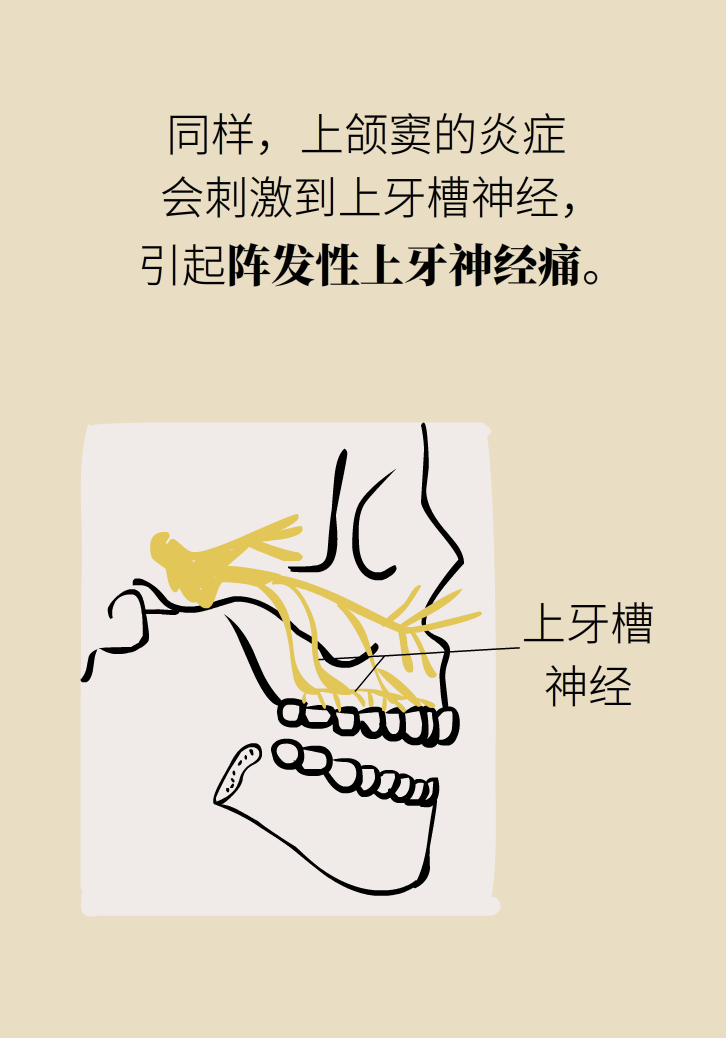 為什么鼻竇發(fā)炎，疼的卻是頭、眼和牙？