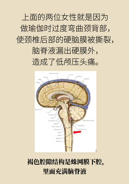 練瑜伽把腦脊液拉漏了！常見的“瑜伽病”你知道多少