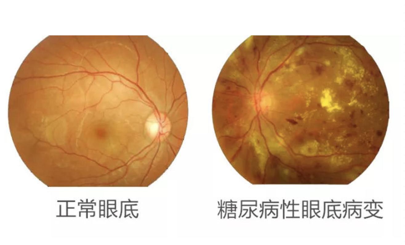 糖尿病患者出現(xiàn)這個(gè)癥狀，可能是失明前兆