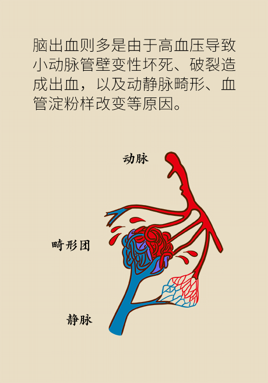 腦出血怎么辦？這些人群要格外注意