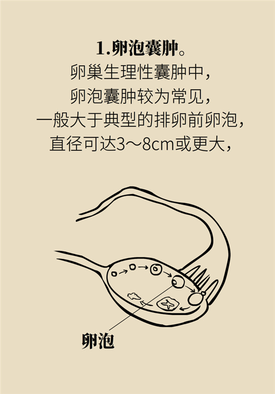 卵巢囊腫科普動(dòng)漫：卵巢囊腫是腫瘤嗎？要學(xué)會(huì)這樣區(qū)分