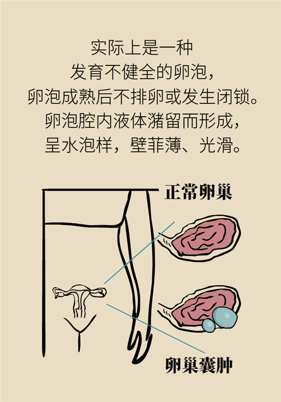 卵巢囊腫科普動(dòng)漫：卵巢囊腫是腫瘤嗎？要學(xué)會(huì)這樣區(qū)分