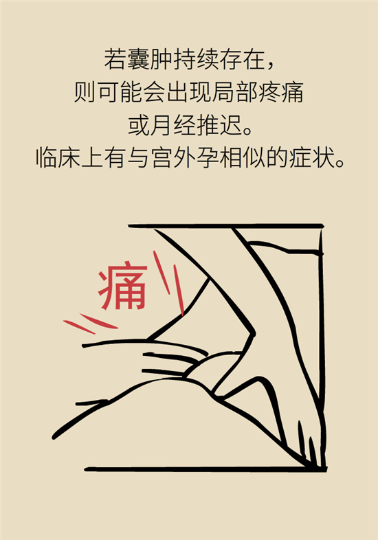 卵巢囊腫科普動(dòng)漫：卵巢囊腫是腫瘤嗎？要學(xué)會(huì)這樣區(qū)分