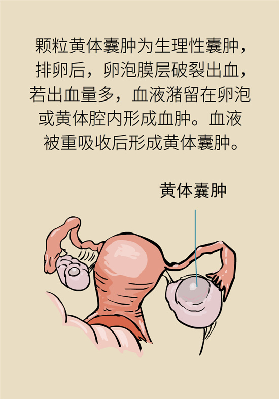 卵巢囊腫科普動(dòng)漫：卵巢囊腫是腫瘤嗎？要學(xué)會(huì)這樣區(qū)分
