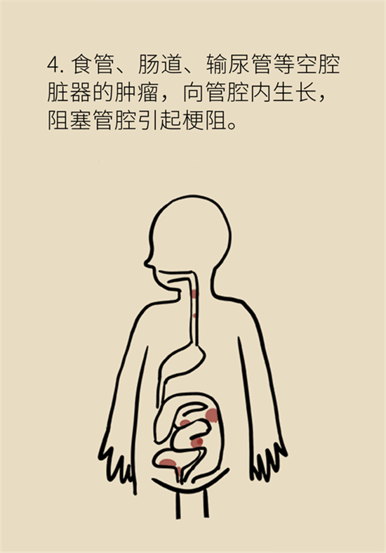 癌癥到底有多痛？需要注意這7個(gè)重點(diǎn)問(wèn)題