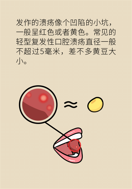口腔潰瘍還想約火鍋？這四種情況一定要高度警惕