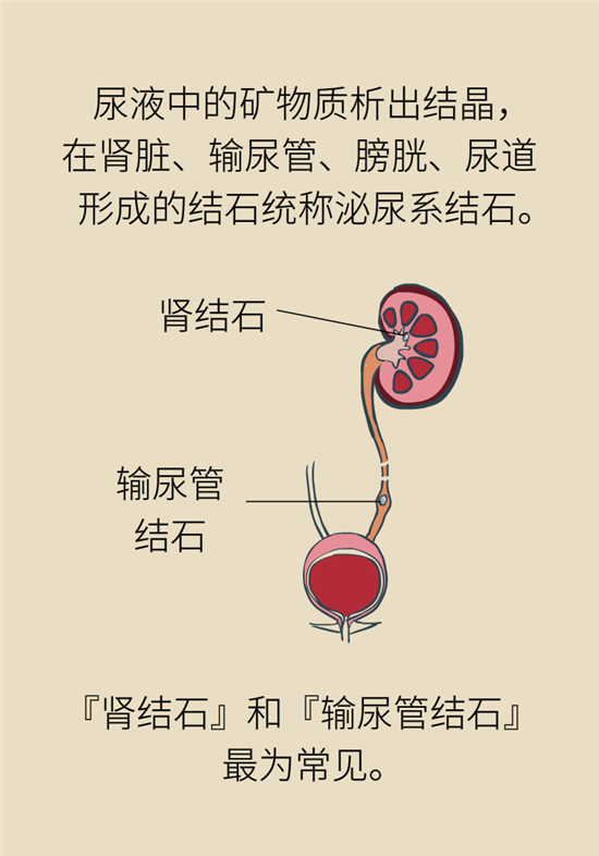 結(jié)石科普：身體里多了各種結(jié)石，應該怎么辦？