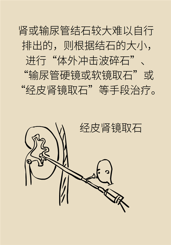 結(jié)石科普：身體里多了各種結(jié)石，應該怎么辦？