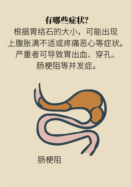 結(jié)石科普：身體里多了各種結(jié)石，應該怎么辦？