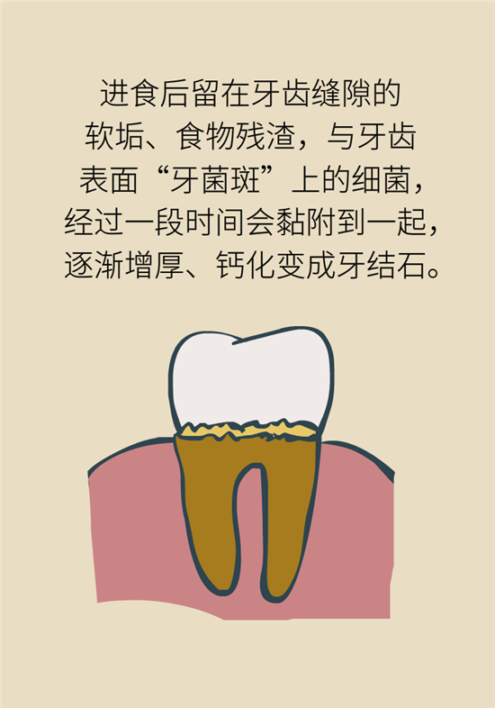 結(jié)石科普：身體里多了各種結(jié)石，應該怎么辦？