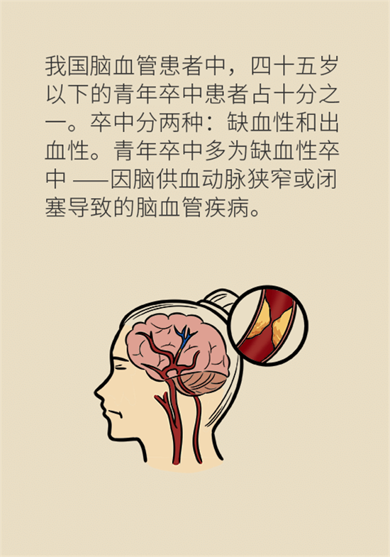 年紀(jì)輕輕別大意，小心腦卒中