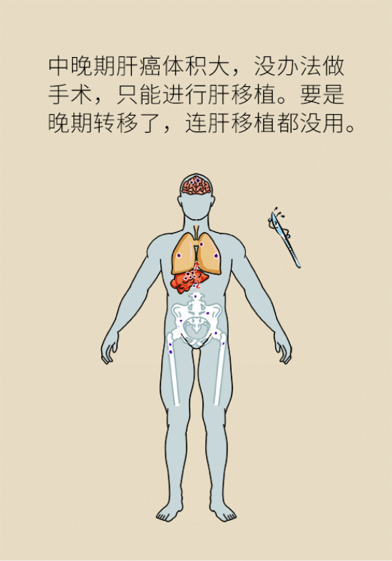 論發(fā)現(xiàn)早期肝癌的本事，cfDNA比AFP更精準(zhǔn)，比影像學(xué)更早一步