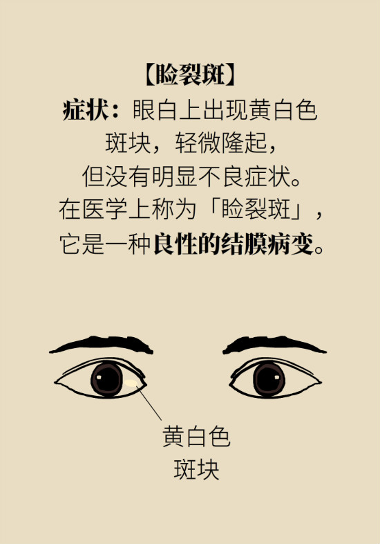 眼白有斑塊、出血要緊嗎？專(zhuān)家：名字唬人但問(wèn)題不大