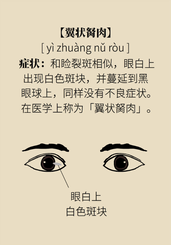 眼白有斑塊、出血要緊嗎？專(zhuān)家：名字唬人但問(wèn)題不大