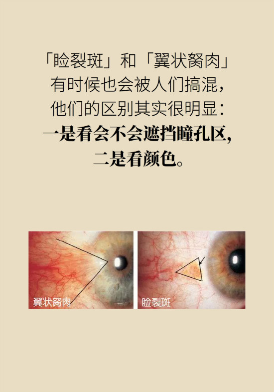 眼白有斑塊、出血要緊嗎？專(zhuān)家：名字唬人但問(wèn)題不大