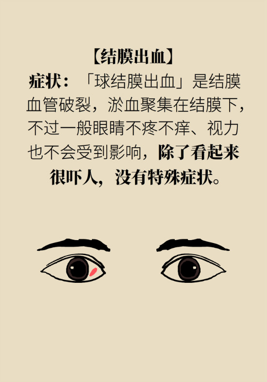 眼白有斑塊、出血要緊嗎？專(zhuān)家：名字唬人但問(wèn)題不大