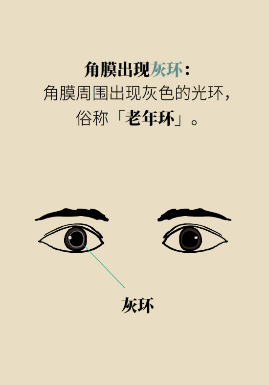 眼白有斑塊、出血要緊嗎？專(zhuān)家：名字唬人但問(wèn)題不大
