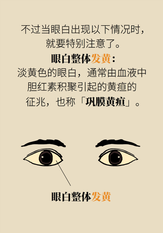 眼白有斑塊、出血要緊嗎？專(zhuān)家：名字唬人但問(wèn)題不大