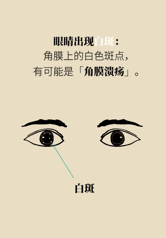 眼白有斑塊、出血要緊嗎？專(zhuān)家：名字唬人但問(wèn)題不大
