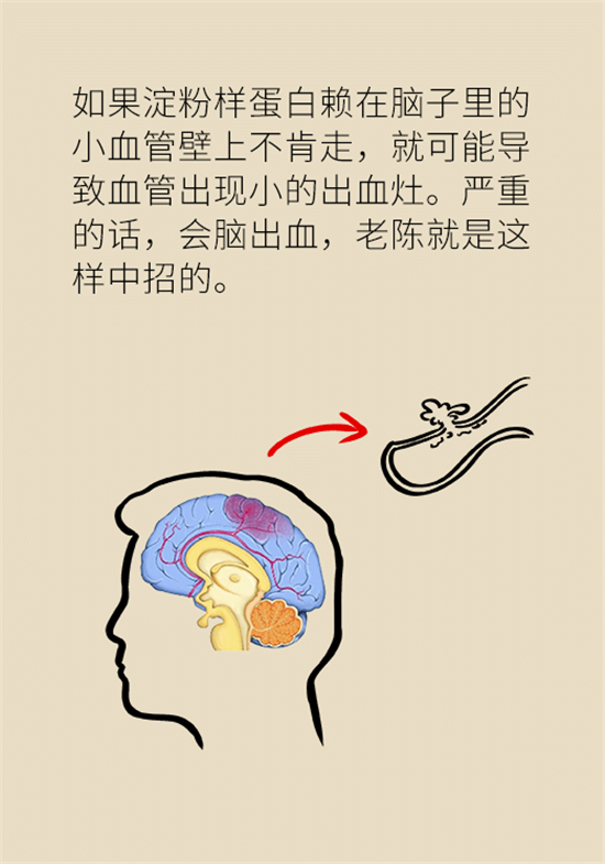 身體出現(xiàn)這些癥狀要小心，可能是腦出血發(fā)出的信號(hào)