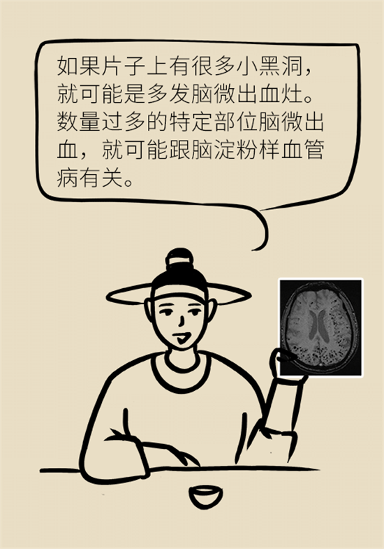 身體出現(xiàn)這些癥狀要小心，可能是腦出血發(fā)出的信號(hào)