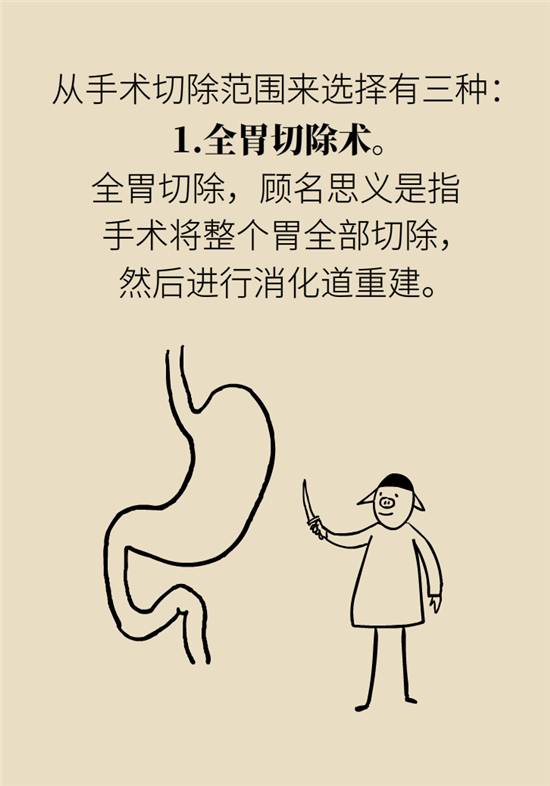 胃癌手術(shù)一定要全切胃？專(zhuān)家：視情況而定