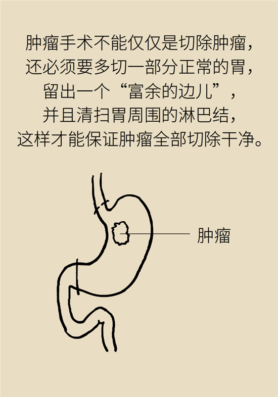 胃癌手術(shù)一定要全切胃？專(zhuān)家：視情況而定