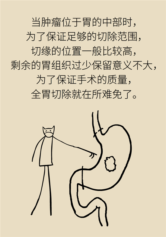胃癌手術(shù)一定要全切胃？專(zhuān)家：視情況而定