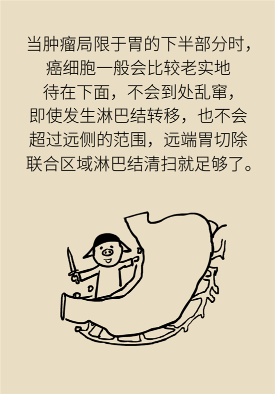 胃癌手術(shù)一定要全切胃？專(zhuān)家：視情況而定