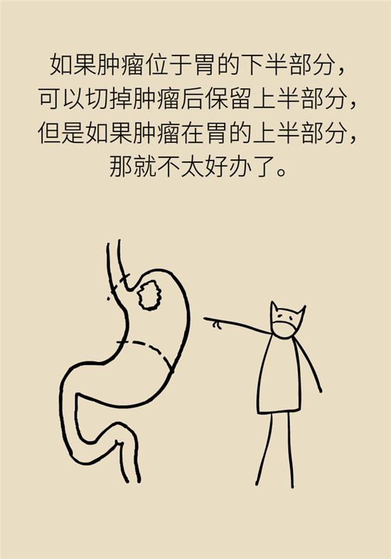 胃癌手術(shù)一定要全切胃？專(zhuān)家：視情況而定