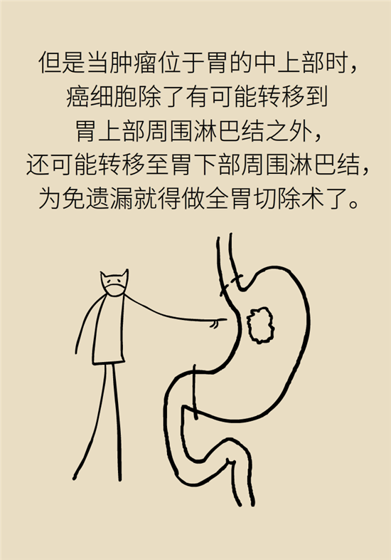 胃癌手術(shù)一定要全切胃？專(zhuān)家：視情況而定