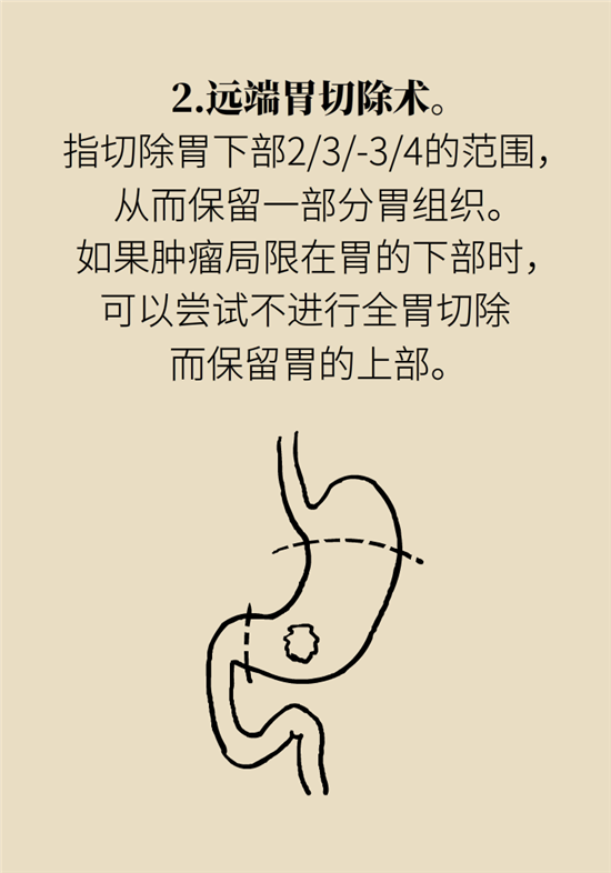 胃癌手術(shù)一定要全切胃？專(zhuān)家：視情況而定