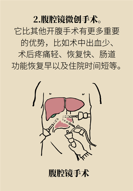 胃癌手術(shù)一定要全切胃？專(zhuān)家：視情況而定