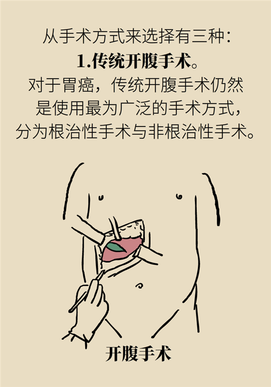 胃癌手術(shù)一定要全切胃？專(zhuān)家：視情況而定
