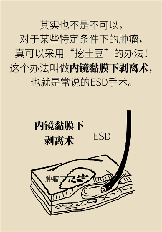 胃癌手術(shù)一定要全切胃？專(zhuān)家：視情況而定