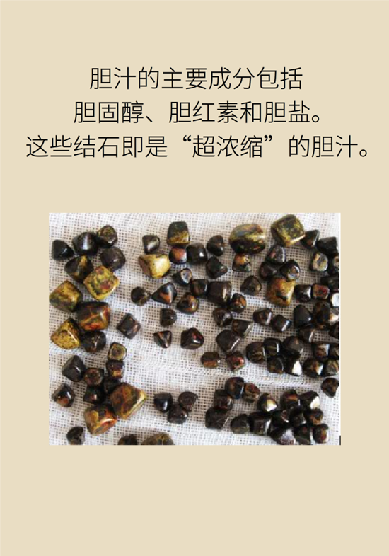 膽結(jié)石主要成分竟是膽固醇？預(yù)防它只需四個(gè)字