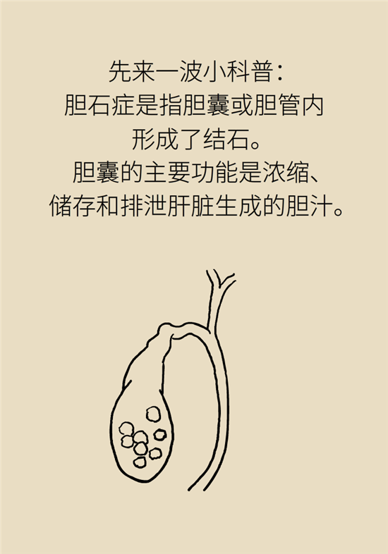 膽結(jié)石主要成分竟是膽固醇？預(yù)防它只需四個(gè)字