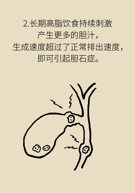 膽結(jié)石主要成分竟是膽固醇？預(yù)防它只需四個(gè)字