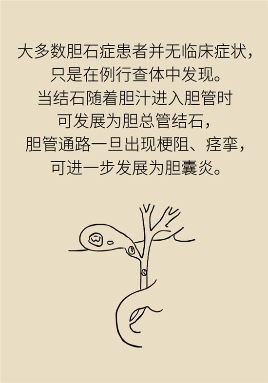 膽結(jié)石主要成分竟是膽固醇？預(yù)防它只需四個(gè)字