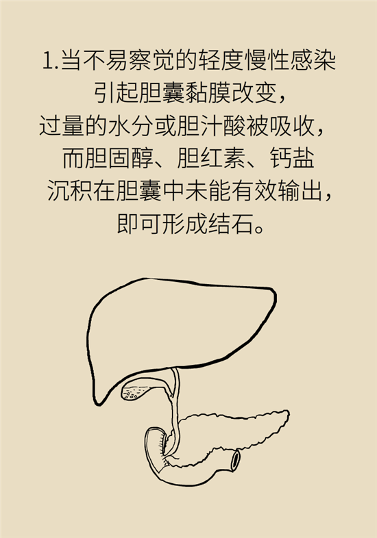 膽結(jié)石主要成分竟是膽固醇？預(yù)防它只需四個(gè)字