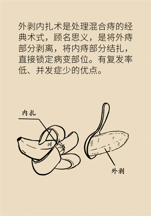 肛門(mén)腫脹還有血？小心痔瘡找上門(mén)