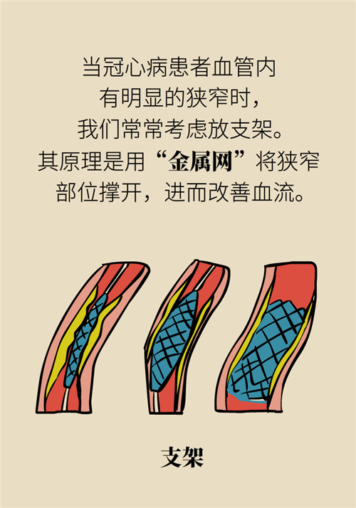 為什么裝完支架猝死風險還增高了？都是因為這些壞習慣